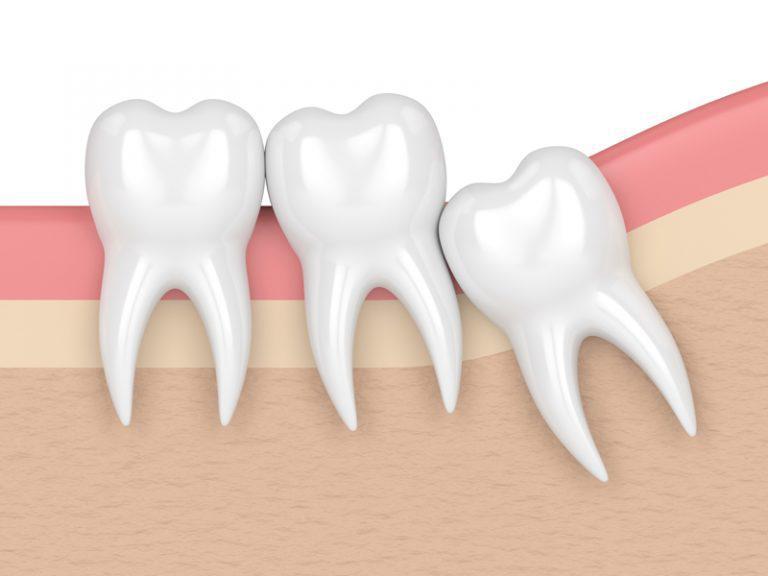 wisdom teeth removal aspendale